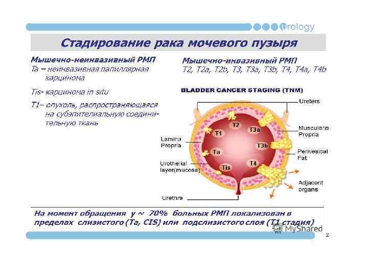 Рак мочевого пузыря: диагностика и лечение в минске