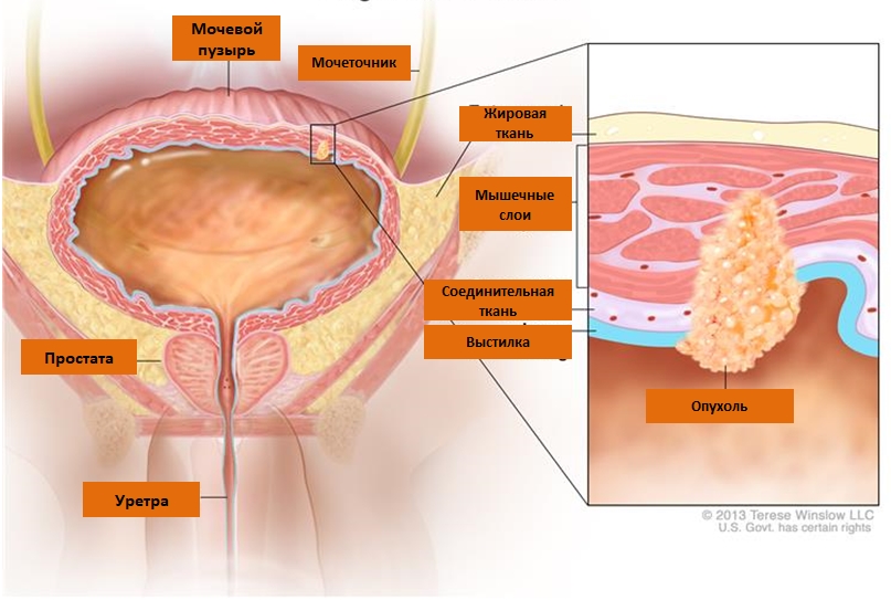 Рак мочевого пузыря: лечение и диагностика